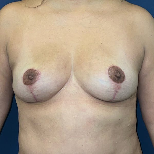 NaturaBra® Mastopexy Before & After Gallery - Patient 107930 - Image 2