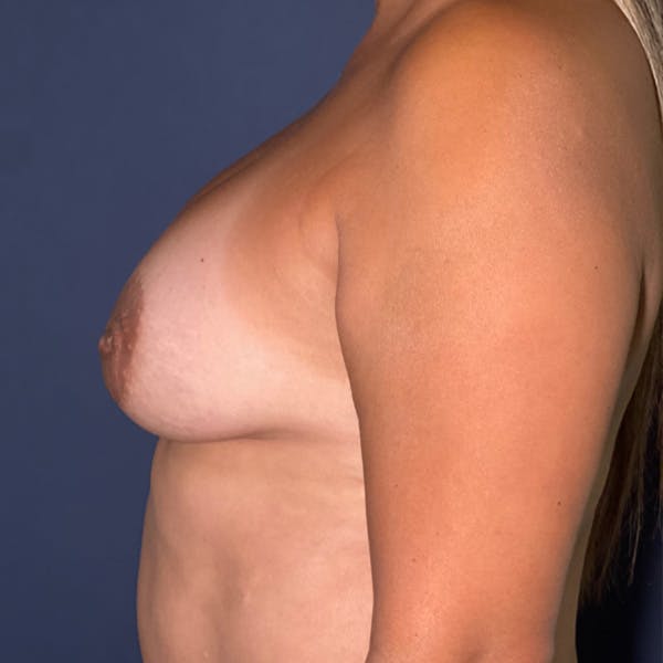 NaturaBra® Mastopexy Before & After Gallery - Patient 107930 - Image 9