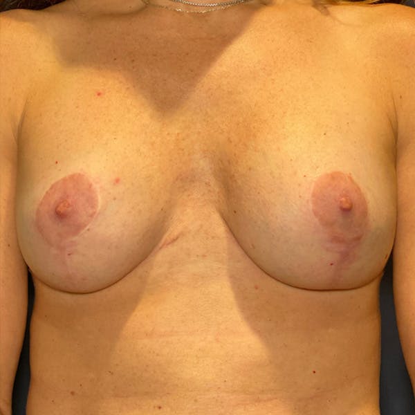 NaturaBra® Mastopexy Before & After Gallery - Patient 210693 - Image 2