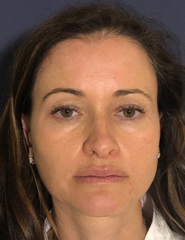 Blepharoplasty (Eyelid Surgery) Before & After Gallery - Patient 575845 - Image 1