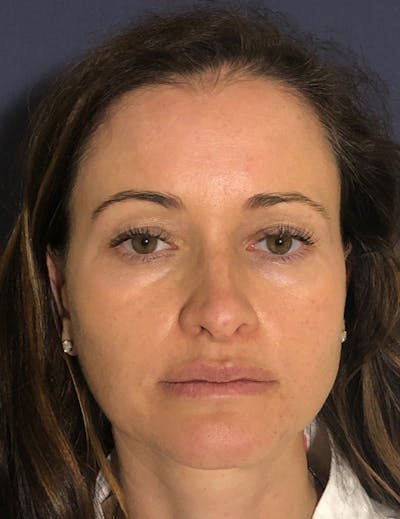 Blepharoplasty (Eyelid Surgery) Before & After Gallery - Patient 575845 - Image 1