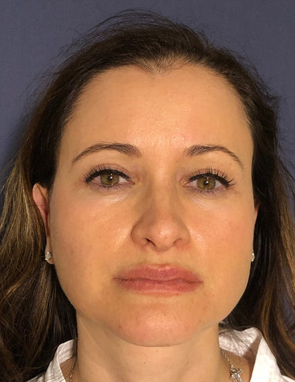 Blepharoplasty (Eyelid Surgery) Before & After Gallery - Patient 575845 - Image 2