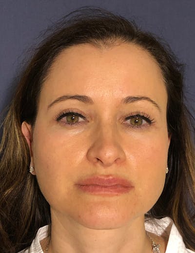 Blepharoplasty (Eyelid Surgery) Before & After Gallery - Patient 575845 - Image 2