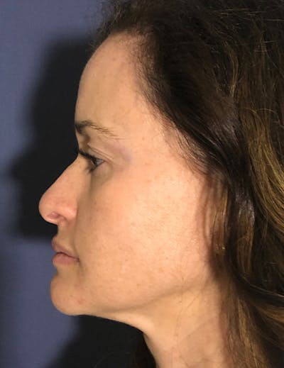 Blepharoplasty (Eyelid Surgery) Before & After Gallery - Patient 575845 - Image 6