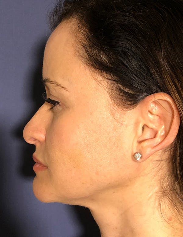 Blepharoplasty (Eyelid Surgery) Before & After Gallery - Patient 575845 - Image 5