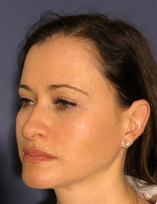 Blepharoplasty (Eyelid Surgery) Before & After Gallery - Patient 575845 - Image 4