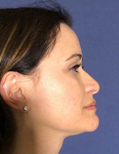 Blepharoplasty (Eyelid Surgery) Before & After Gallery - Patient 575845 - Image 8