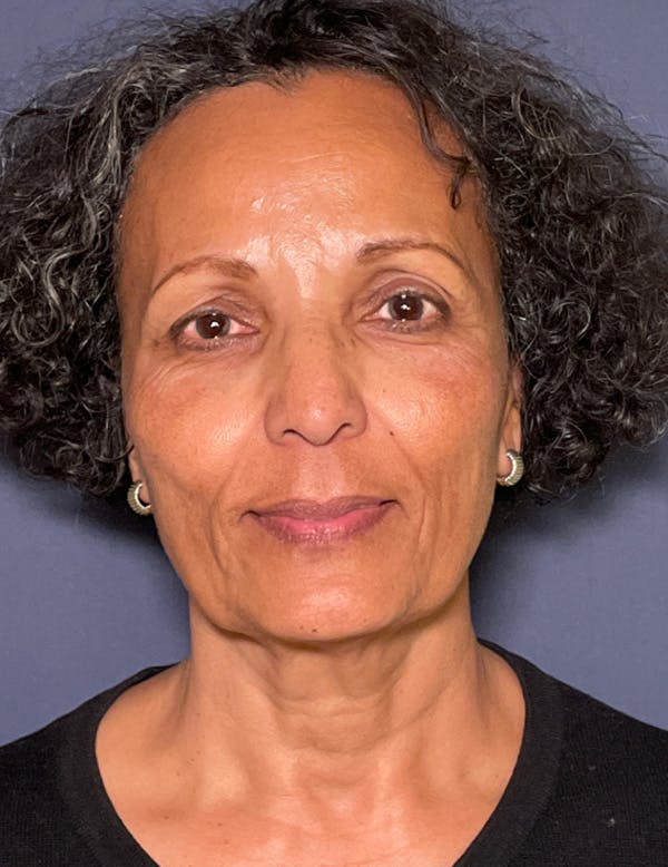NaturaBrow® Before & After Gallery - Patient 172380 - Image 1