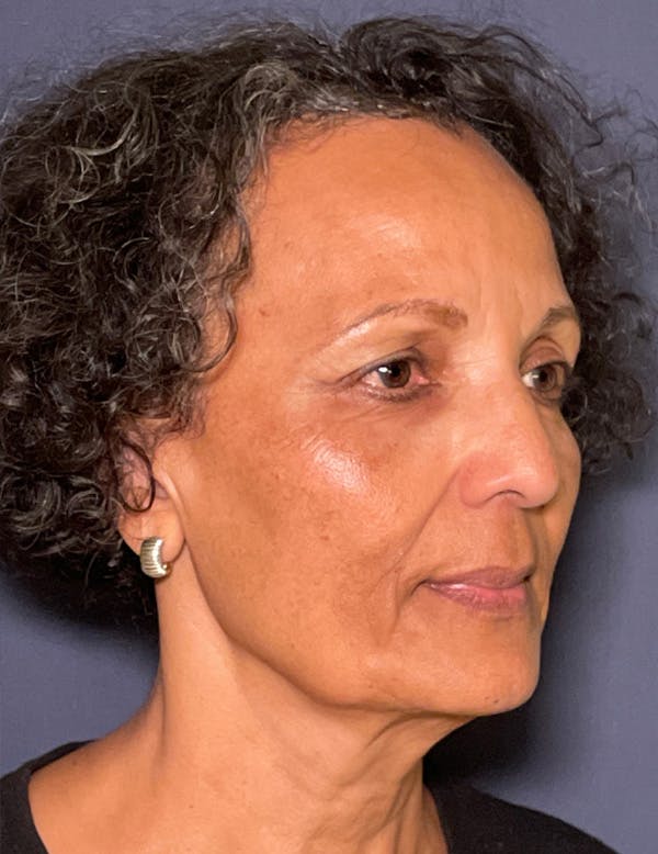 NaturaBrow® Before & After Gallery - Patient 172380 - Image 3