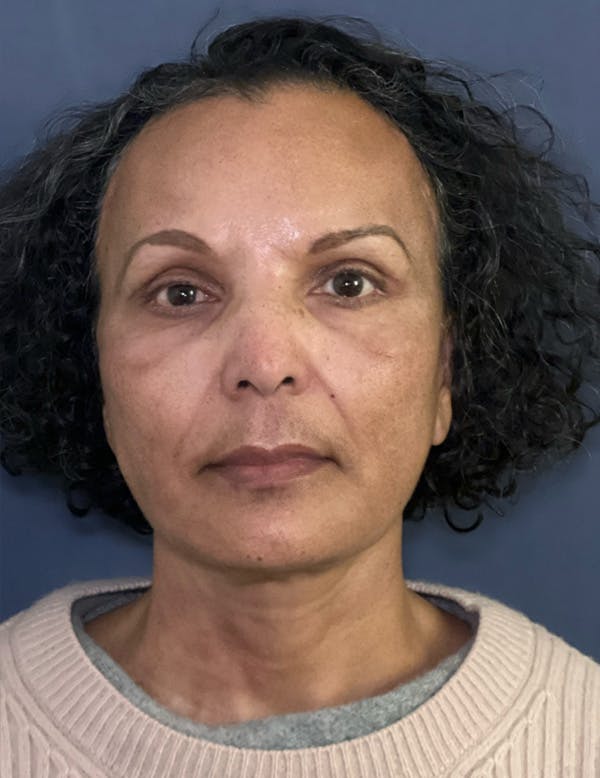 NaturaBrow® Before & After Gallery - Patient 172380 - Image 2
