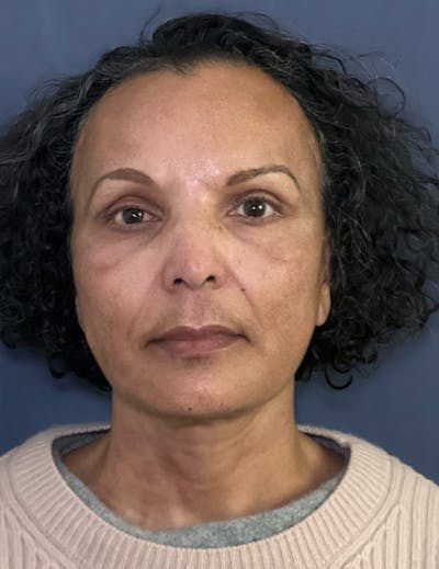 NaturaBrow® Before & After Gallery - Patient 172380 - Image 2