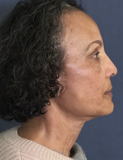 NaturaBrow® Before & After Gallery - Patient 172380 - Image 6