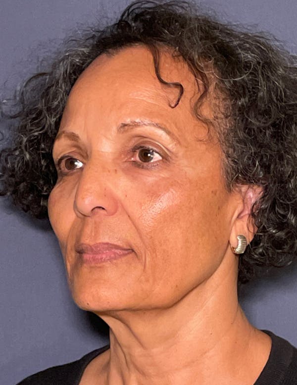 NaturaBrow® Before & After Gallery - Patient 172380 - Image 7