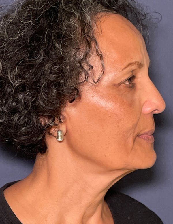 NaturaBrow® Before & After Gallery - Patient 172380 - Image 5