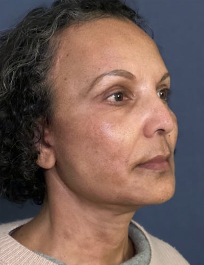 NaturaBrow® Before & After Gallery - Patient 172380 - Image 4
