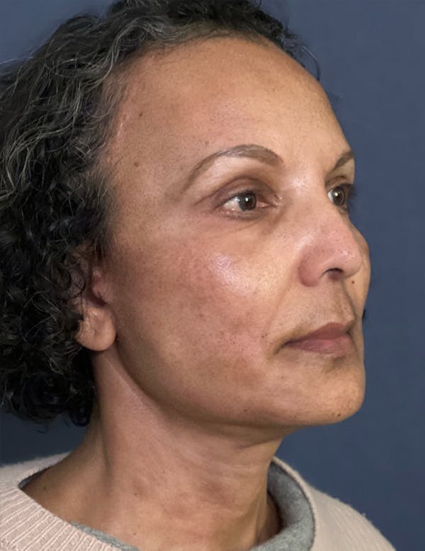 NaturaBrow® Before & After Gallery - Patient 172380 - Image 4