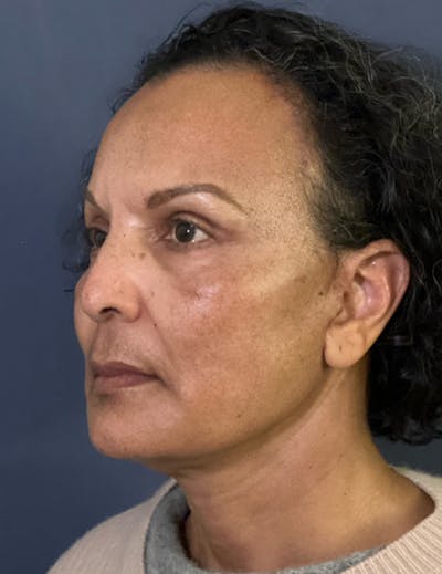 NaturaBrow® Before & After Gallery - Patient 172380 - Image 8