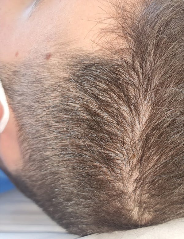 Exosomes/ExoBoost Before & After Gallery - Patient 157635 - Image 3