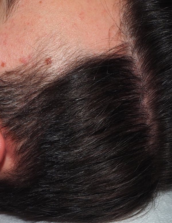 Exosomes/ExoBoost Before & After Gallery - Patient 157635 - Image 4