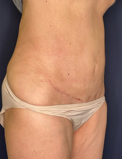 Tummy Tuck (Abdominoplasty) Before & After Gallery - Patient 341313 - Image 4