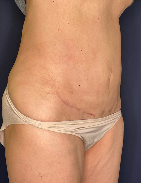 Tummy Tuck (Abdominoplasty) Before & After Gallery - Patient 341313 - Image 4