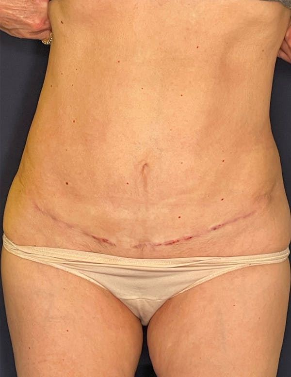 Tummy Tuck (Abdominoplasty) Before & After Gallery - Patient 341313 - Image 2