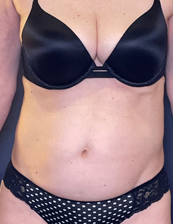 Tummy Tuck (Abdominoplasty) Before & After Gallery - Patient 341313 - Image 1