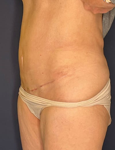Tummy Tuck (Abdominoplasty) Before & After Gallery - Patient 341313 - Image 6
