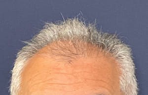 Before and After Hair Restoration in NYC