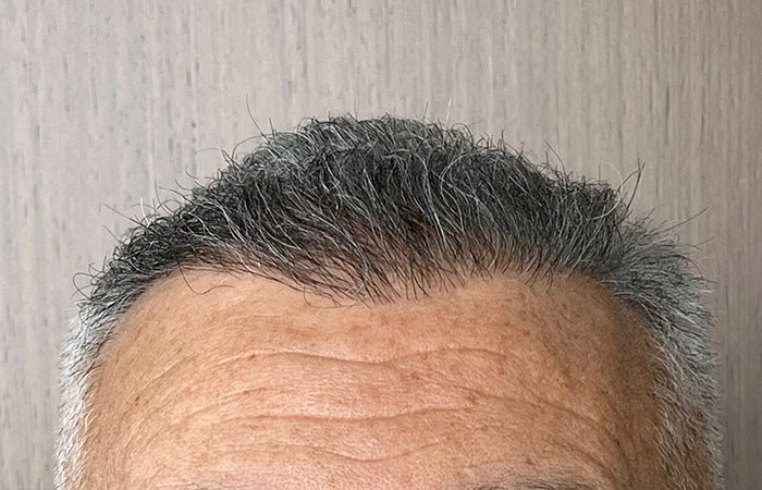 after hair grafts
