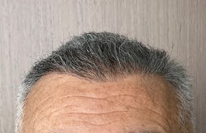 Before and After Hair Restoration in NYC