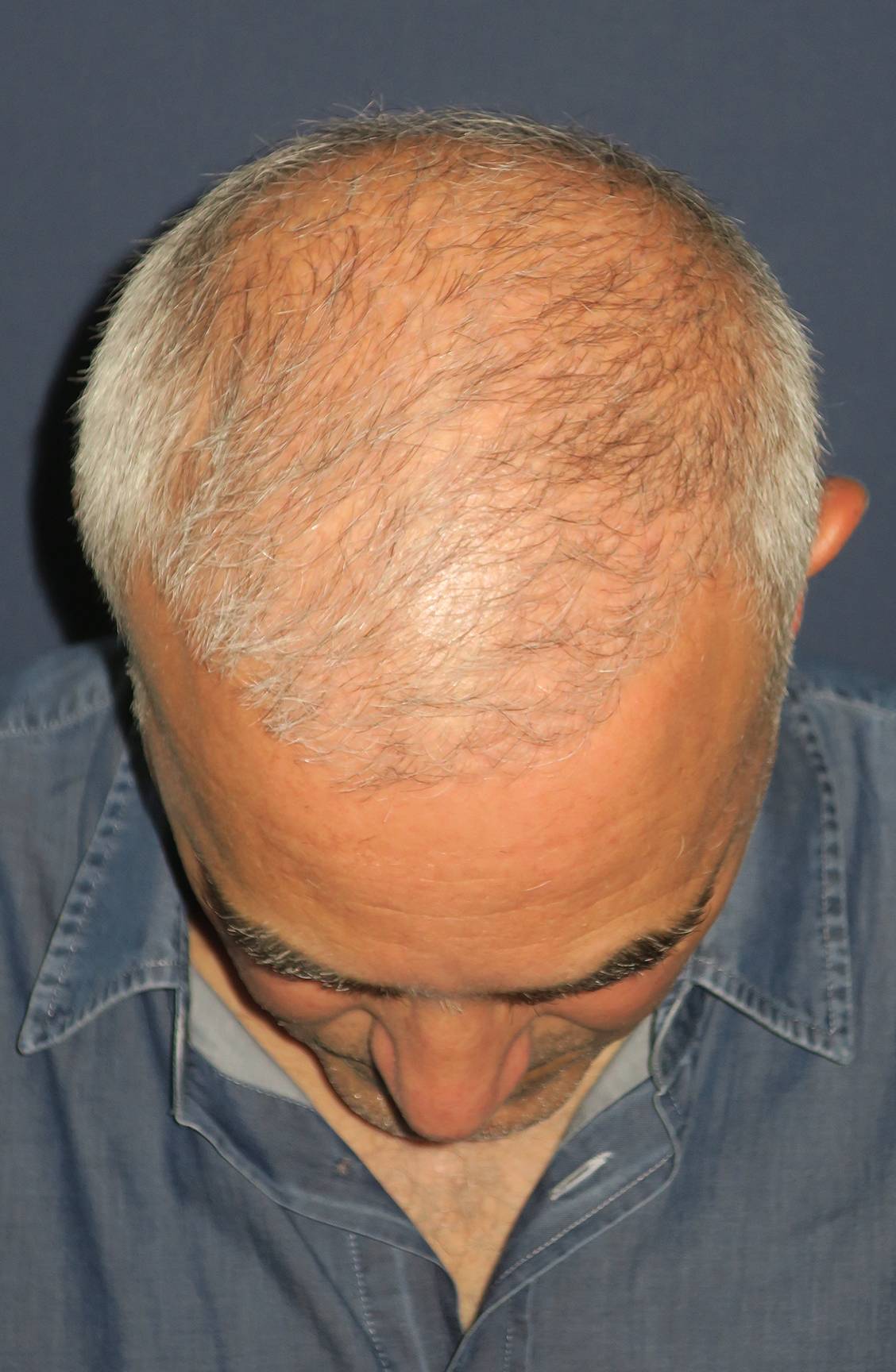 before hair grafts