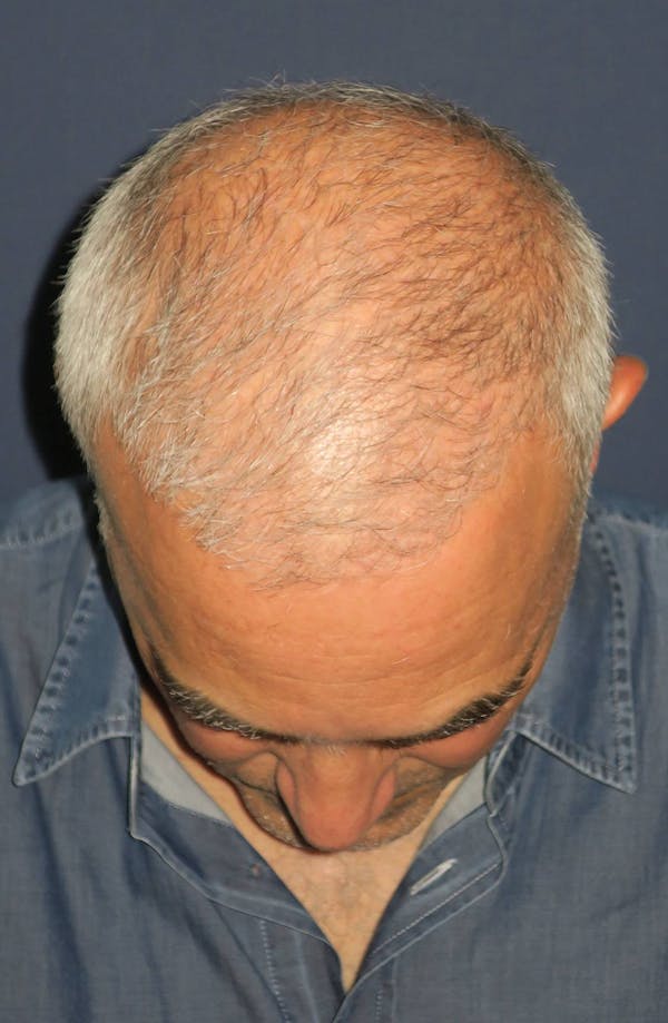PRF/Platinum PRP 2.0 for Hair Restoration Before & After Gallery - Patient 4453635 - Image 5