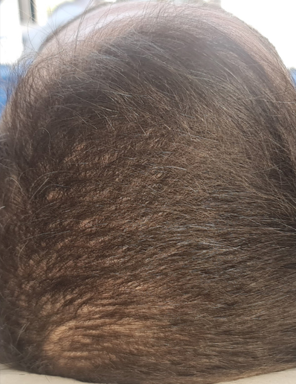 before hair grafts