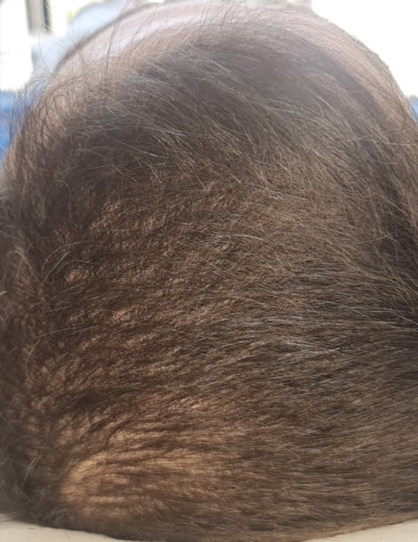 Exosomes/ExoBoost Before & After Gallery - Patient 157635 - Image 1