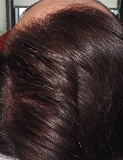 Exosomes/ExoBoost Before & After Gallery - Patient 157635 - Image 2