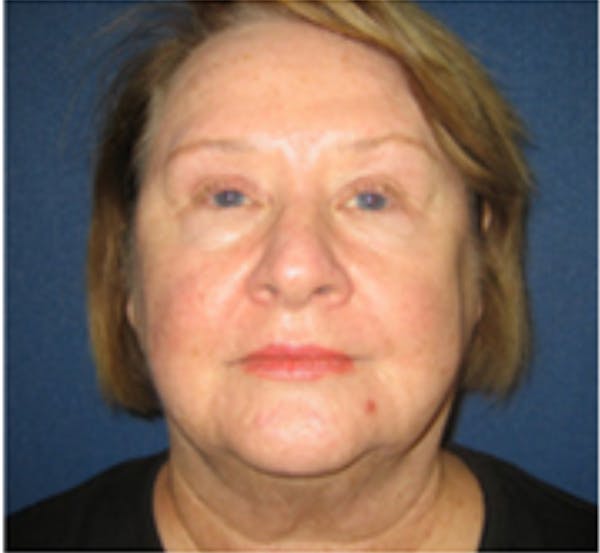 Facelift Before & After Gallery - Patient 196874 - Image 1