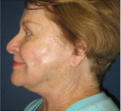 Facelift Before & After Gallery - Patient 196874 - Image 4