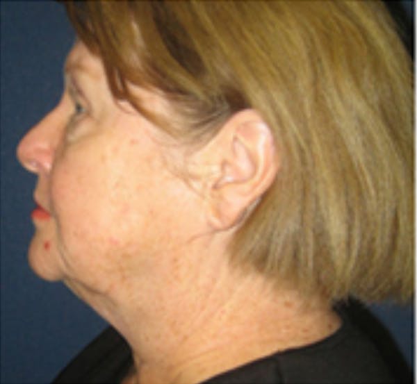 Facelift Before & After Gallery - Patient 196874 - Image 3