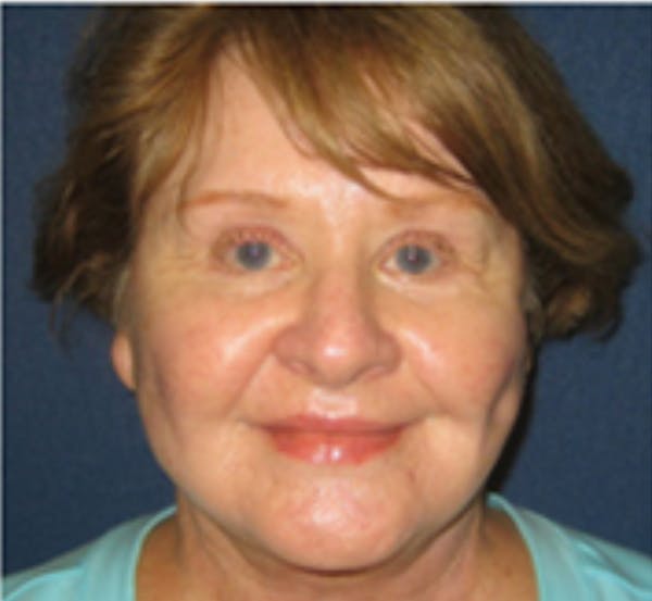 Facelift Before & After Gallery - Patient 196874 - Image 2