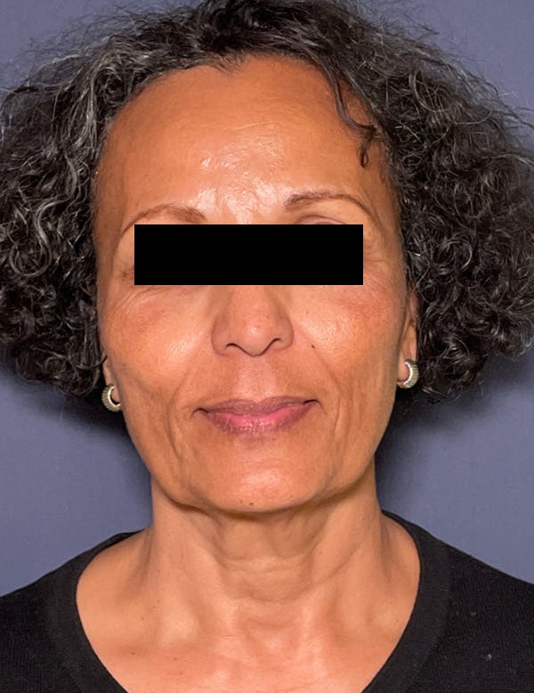 Facelift Before & After Gallery - Patient 245745 - Image 1