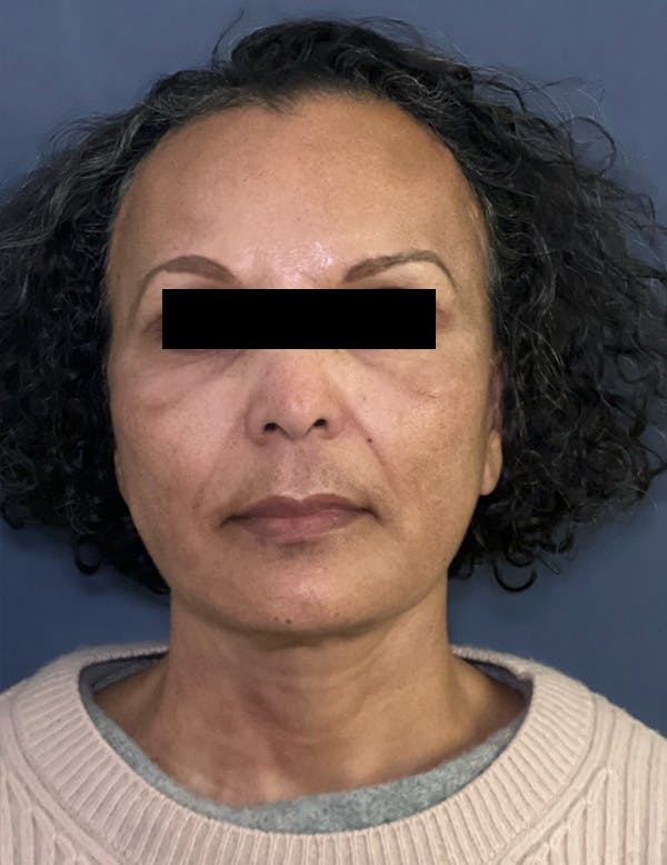 Facelift Before & After Gallery - Patient 245745 - Image 2