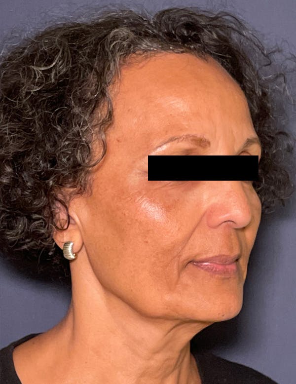 Facelift Before & After Gallery - Patient 245745 - Image 3
