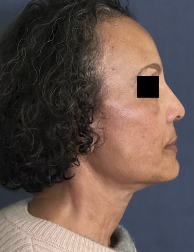 Facelift Before & After Gallery - Patient 245745 - Image 6