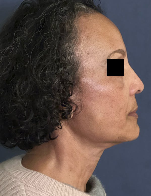 Facelift Before & After Gallery - Patient 245745 - Image 6