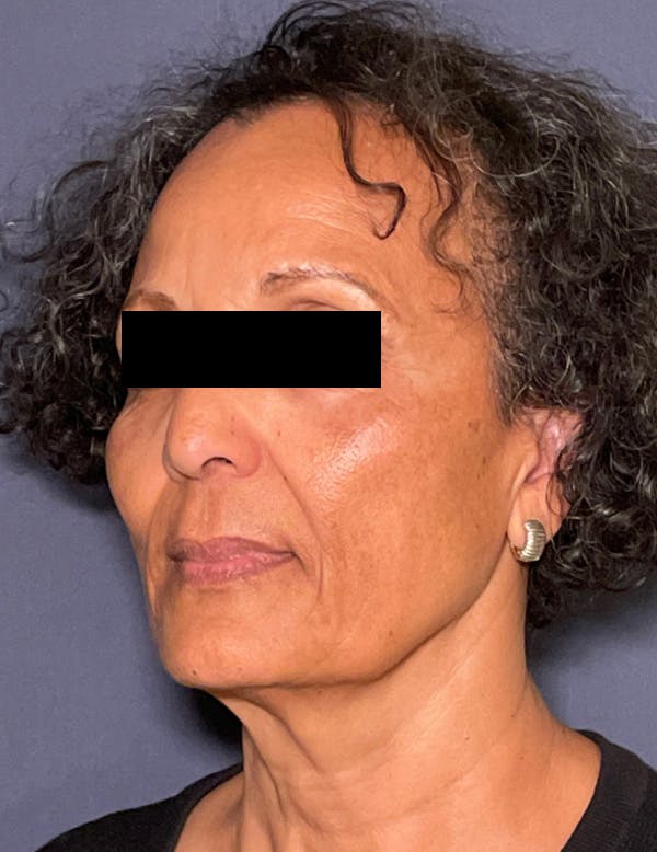 Facelift Before & After Gallery - Patient 245745 - Image 7