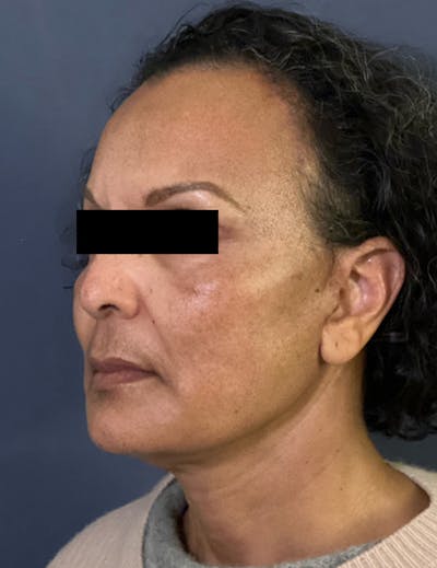 Facelift Before & After Gallery - Patient 245745 - Image 8