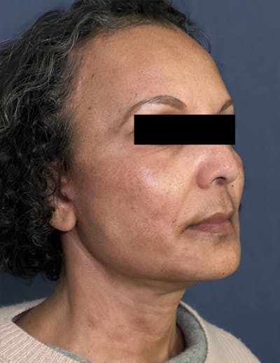 Facelift Before & After Gallery - Patient 245745 - Image 4