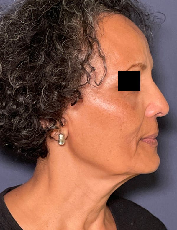 Facelift Before & After Gallery - Patient 245745 - Image 5