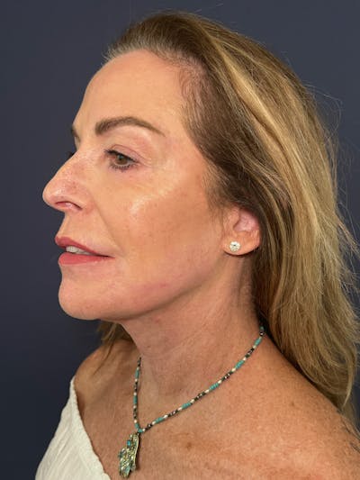 Facelift Before & After Gallery - Patient 174003314 - Image 6